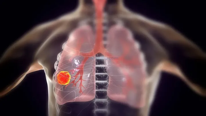 BioNTech’ten Akciğer Kanserinde Dikkat Çeken Sonuç: Yaşam Süresi Neredeyse İkiye Katlandı